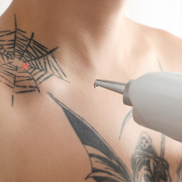 Remoção de Tatuagem